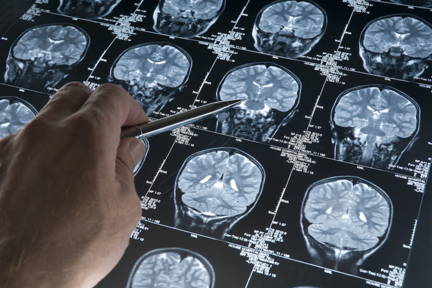 Espoir pour traiter la maladie d’Alzheimer